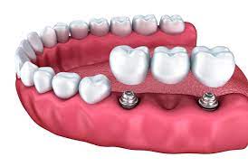 Implante de 3 Dentes Juntos curitiba