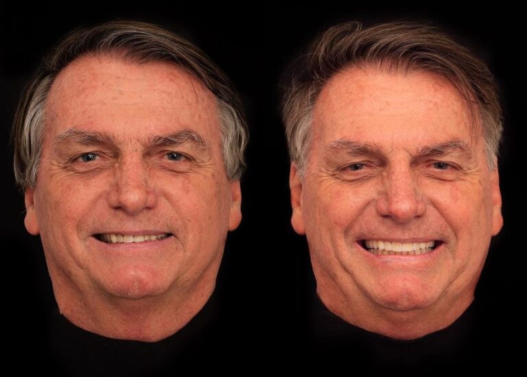 Bolsonaro gasta R$ 84 mil em tratamento estético para harmonização do sorriso